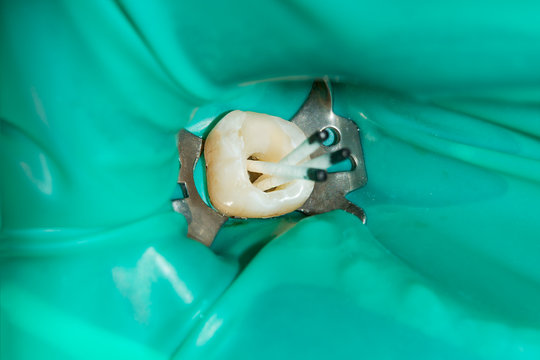 treatment and restoration of rotten carious tooth after root canal filling endocanal pins from fiberglass and photopolymer sealing material
