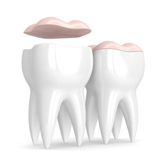 3d render of teeth with dental onlay
