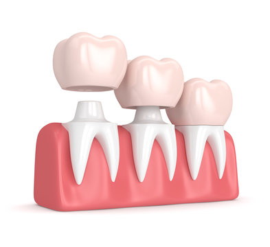 3d render of  replacement crowns cemented onto reshaped teeth