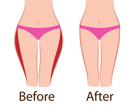 Vetor de Fat and slim girls' hips. Before and after. do Stock