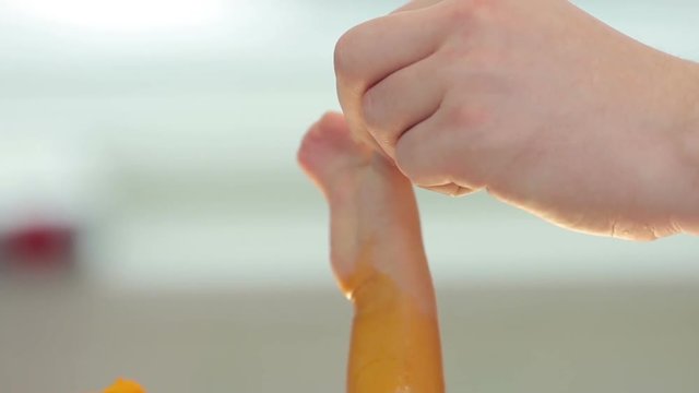 Surgeon treats the child's hand with fused fingers because of syndactyly disease close-up (1080p, 50fps)