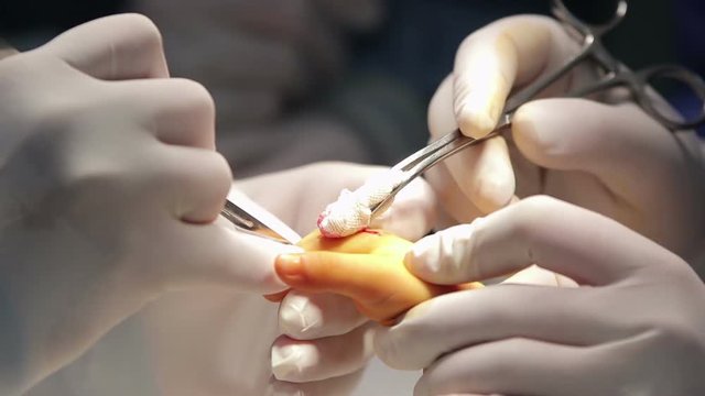 Microsurgeon makes first incision on a fused fingers with a scalpel during the surgery of 

a child with syndactyly macro (1080p, 50fps)
