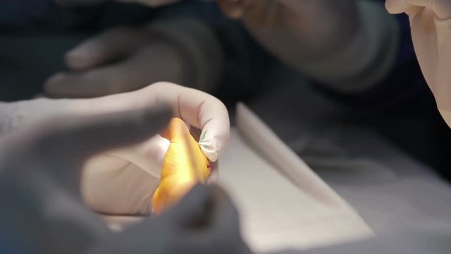 Microsurgeon separetes fused fingers with a scalpel during the surgery of a child with 

syndactyly macro (1080p, 50fps)
