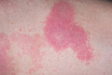 Itchy urticaria on woman leg
