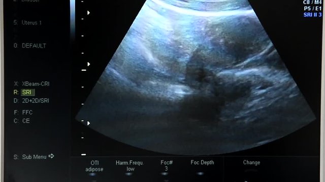 Screen of  ultrasound machine. 