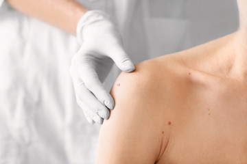 Obraz na płótnie Canvas Dermatologist examining birthmark of patient, closeup. Cancer concept