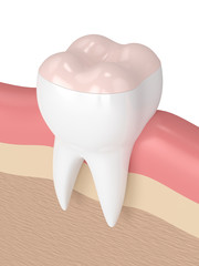 3d render of tooth with dental onlay filling