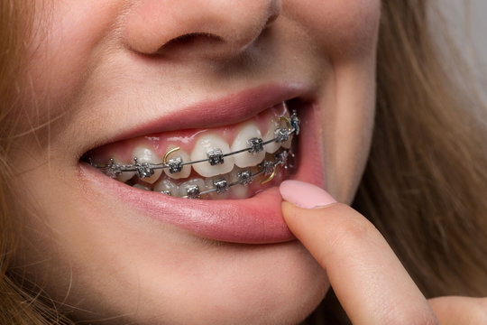 Mund einer jungen Frau mit fester Zahnklammer und Finger an der Lippe