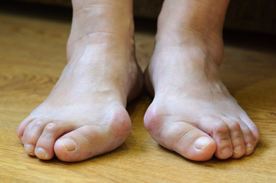 Problem feet with bunion (Hallux valgus)
