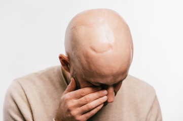 Fototapeta premium Bald man psychological stress struggling for life arter brain tumor. Heartbreaking male emotions after cancer neurosurgery operation. Oncology survivor patient. Chemotherapy and irradiation head marks