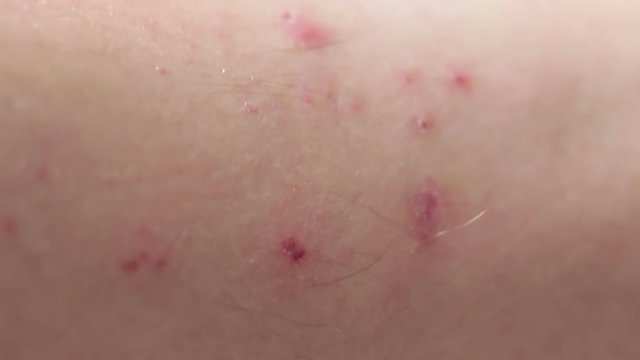Pimples or mosquito bites on a person's skin. Close-up