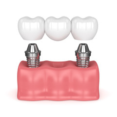 3d render of implants with dental bridge