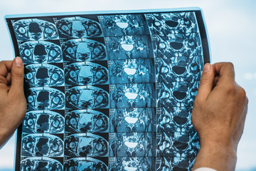 Doctor holds MRI scan or X-Ray film of heap joint