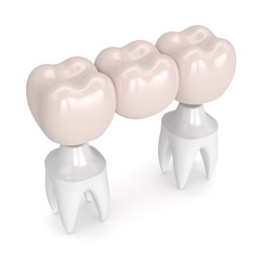 3d render of dental bridge with dental crowns