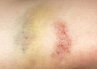 Large bruises and abrasions on human skin.