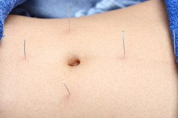Close up Hand Perform Medical of professional acupuncture treatment