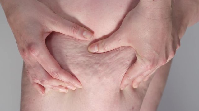 SLOW MOTION, CLOSE UP, MACRO: Unrecognizable woman squeezes the side of her thigh and reveals cellulite. Chubby individual has cellulite due to poor diet and unhealthy lifestyle. Risk of heart disease