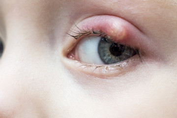 Close up right upper eye lid abscess, stye or hordeolum