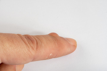 Ganglion Cysts