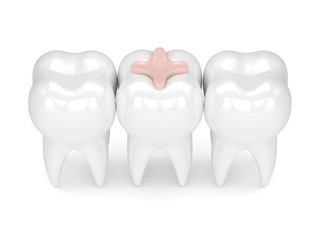 3d render of teeth with dental inlay filling