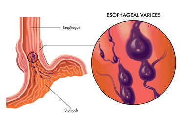 medical vector illustration of symptoms of esophageal varices