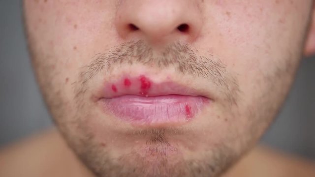 Detail of Herpes on lip of man