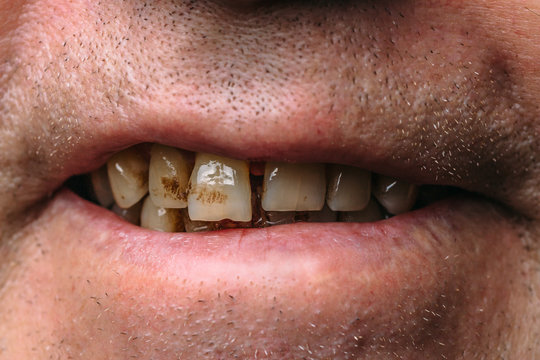 Smiling mouth of smoker man with yellow teeth and tartar