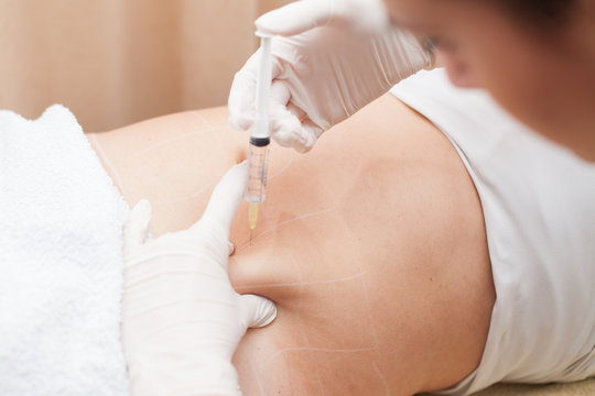 mesotherapy treatment on woman's body