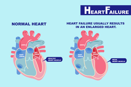 heart failure concept