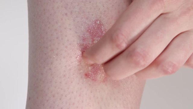 CLOSE UP: Unrecognizable female scratching red, inflamed and painful scaly skin patches. Psoriasis patient struggling with autoimmune disease. Young woman with grose itchy allergy scratching dry rash