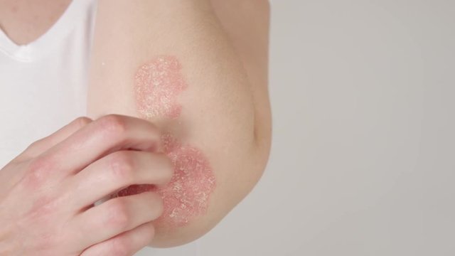 CLOSE UP: Unrecognizable young woman suffering from autoimmune incurable dermatological skin disease called psoriasis. Female gently scratching red, inflamed, scaly rash on elbows. Psoriatic arthritis