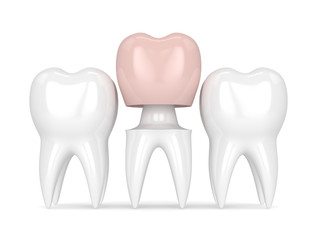 3d render of teeth with dental crown restoration