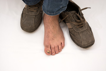poor footwear as the cause of the disease, fungal infection of toenails, showing diseased nails on a clean white cotton fabric