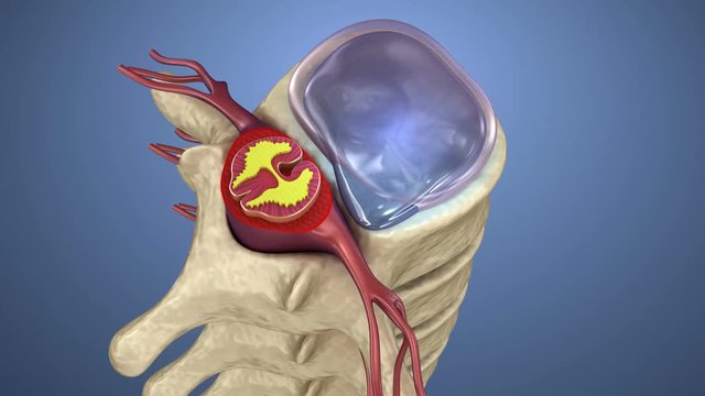 Spinal cord under pressure of bulging disc, 3d animation