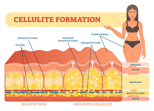 Cellulite formation vector illustration diagram, medical information scheme. 