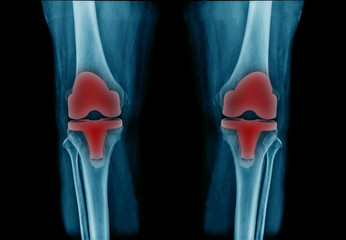 x-ray image total knee athoplasty