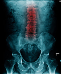 x-ray image show l-spondylosis and stenosis and loss space of disc