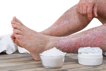 Psoriasis skin lesions