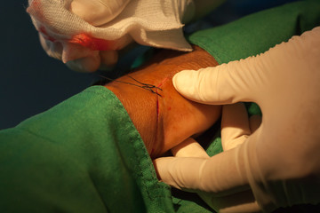 thread suturing wound