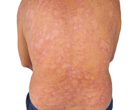 Tinea corporis , Fungal infection or Mycosis