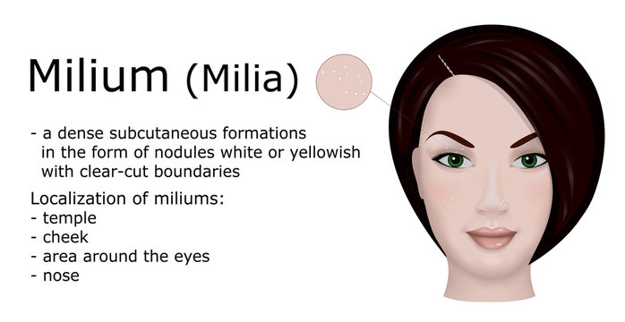 Illustration of Milium