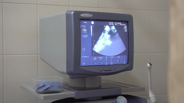 Ultrasonic diagnostics. Monitor with ultrasonic interactive echogram pictures