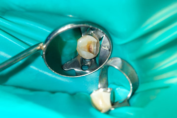 close-up of a human rotten carious tooth at the treatment stage in a dental clinic