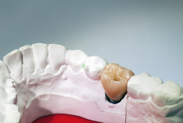 Gypsum dental model with ceramic tooth