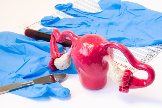 Uterus and ovaries genital female surgery concept. Model of uterus and ovaries near scalpel, surgical gloves and blood test tube with blood result. Indications for surgery or surgical operation