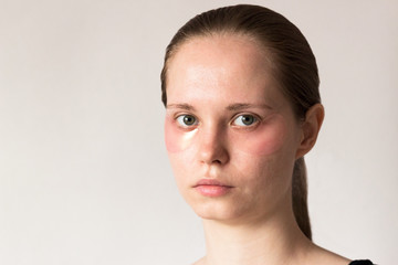 Fototapeta premium Girl uses pink hydrogel patches under her eyes. Cosmetology, self-care.