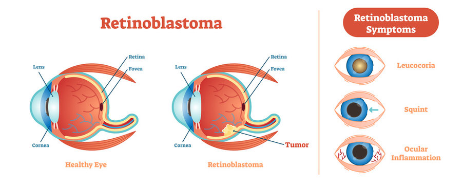 Retinoblastoma vector illustration diagram, anatomical scheme. 