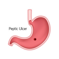Fototapeta premium Cross section of human stomach. Peptic ulcer, human heath care. Vector illustration isolated on white background