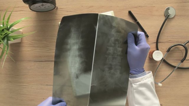 Overhead view of doctor analyzing x-ray of the patient's spine in a medical clinic. Healthcare professional examining imaging test for abnormalities in human backbone.