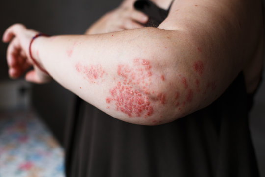 The problem with many people - eczema on hand. Dark background. Man itchind skin.